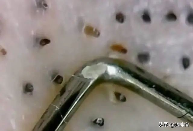 比痘痘更烦人的闭口来了，最有效的去闭口*法大**看过来