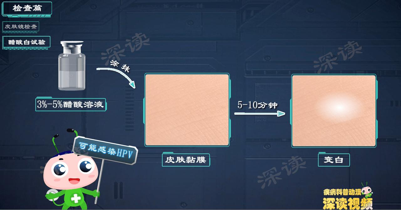 液氮冷冻治疗尖锐湿疣没感觉,液氮冷冻治疗尖锐湿疣注意事项