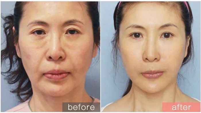 超声刀图解100例,从破坏开始的科学