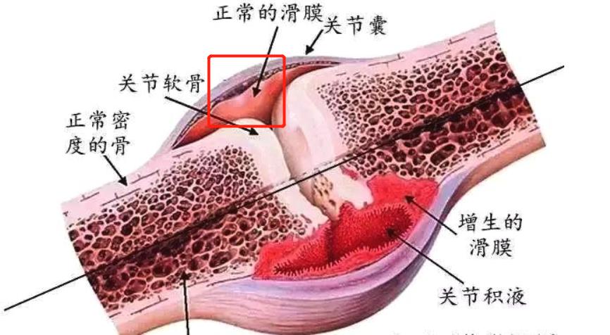 膝盖有滑膜炎，还能治愈吗？该怎么办？不想手术，3个要点需牢记