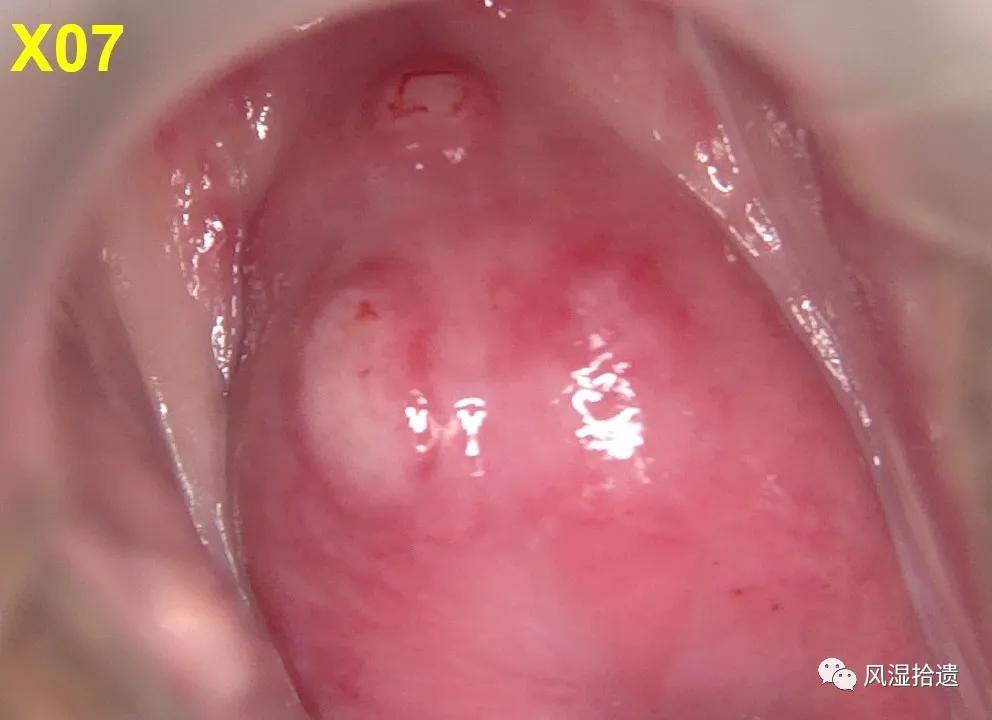 「病例分享」阴道镜和胃镜检查后发现的白塞病