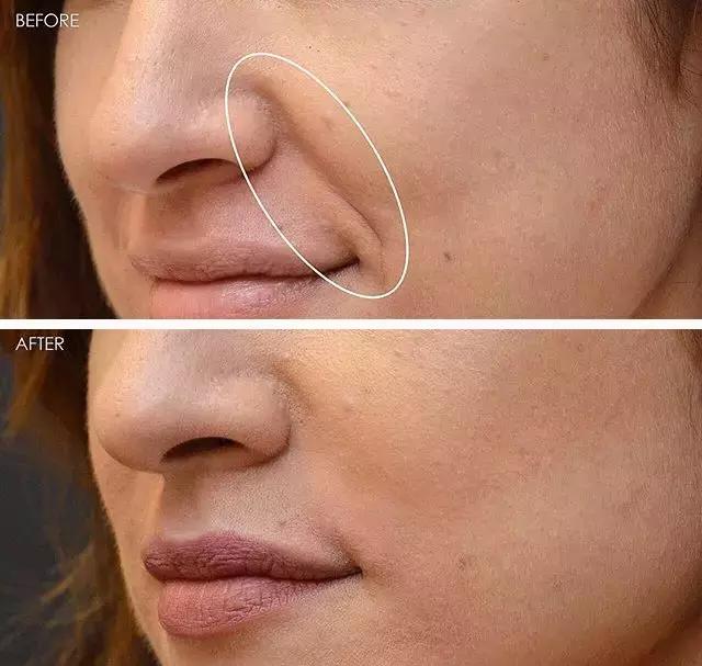 硬刚女皇龙妈也扛不住法令纹,2条沟壑让人心疼,贴一贴就消了