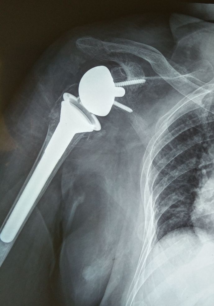 病例分享:不论什么疾病,只要有功能问题,就需要规范化康复治疗