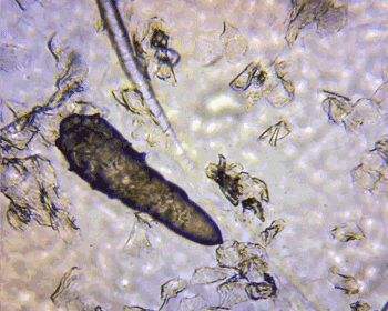 痘痘反反复复该如何根治,痘痘感染成红色疙瘩一直不消