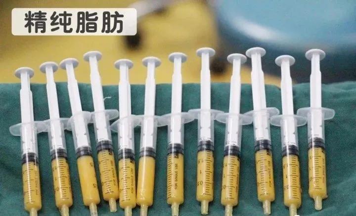 自体脂肪填充全脸逆袭,自体脂肪填充的真相来了