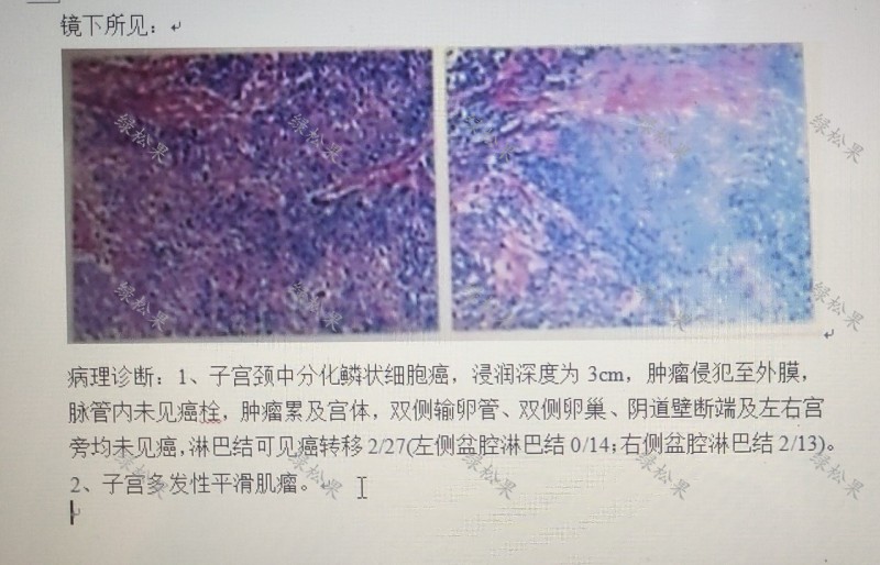 绝经几年了下身出血是宫颈癌吗,绝经后多年又出血一定是宫颈癌吗