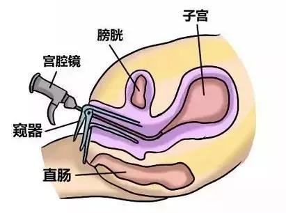 对宫腔粘连存在的疑问,宫腔粘连医生说不影响怀孕为什么