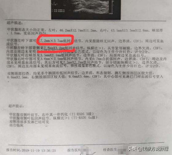 甲状腺结节3类有药吃能治好吗,甲状腺结节3类喝中药能治好么