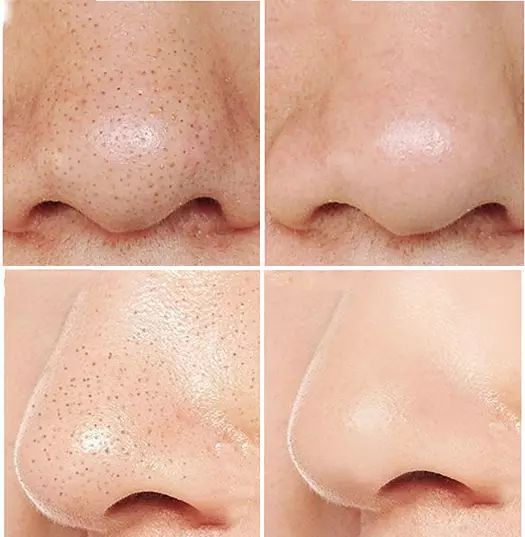 赵丽颖黑头,赵丽颖素颜照片真实对比