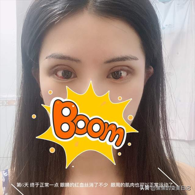 双眼皮知识点总结大全,关于双眼皮的十大真相