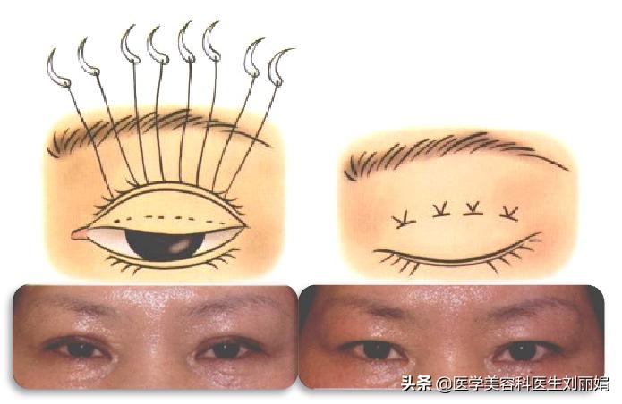 尚雯婕单眼皮吗,尚雯婕参加王牌视频