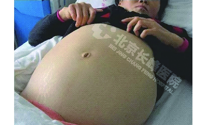 肝血管瘤不治会怎么样,肝血管瘤切除术后一个月复查什么