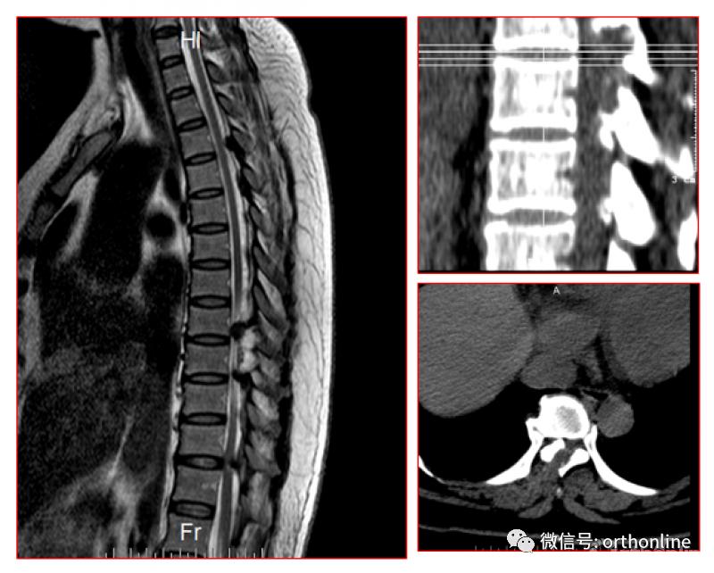 胸椎怎么做微创,脊柱内镜微创操作流程
