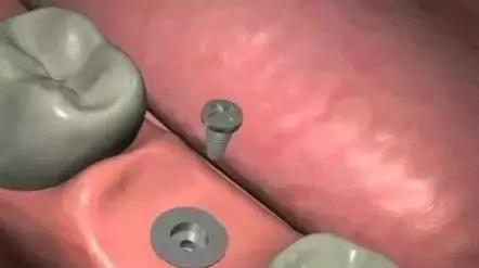 3d打印种植牙与传统种植牙的区别,种植牙是怎样种植的如何操作