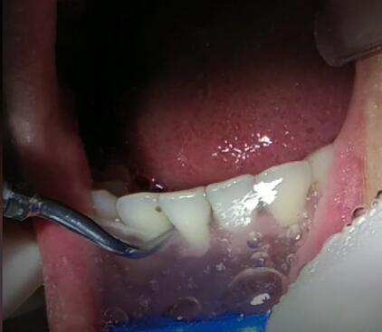 洗牙对牙齿有伤害吗能美白牙齿吗,洗牙美白的最快方法