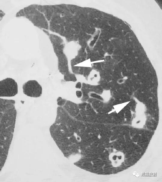 长期卧床病人肺部并发症,卧床患者肺部感染并发症