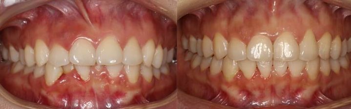 深覆盖vs深覆合,深覆盖和深覆合哪个难度大