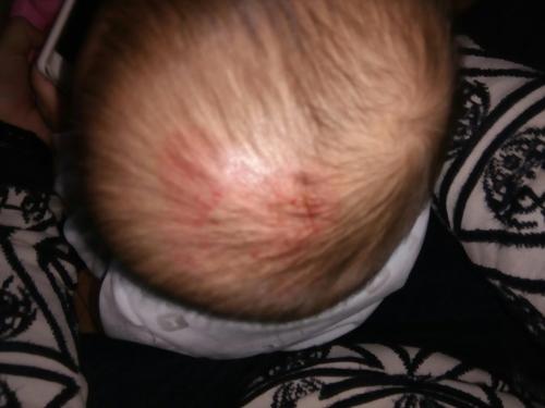 小孩摔出皮下血肿怎么处理,孩子头部摔了有血肿软的