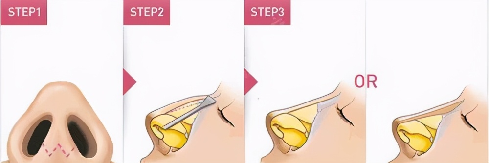 鼻子整形难看吗,鼻子丑只能整吗