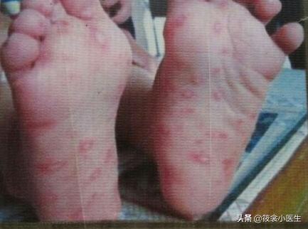 手足口病容易和哪些病混淆,儿科医生手足口病