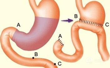 胆汁反流性胃炎到底有哪些原因,胆汁反流性胃炎的快速解决方法