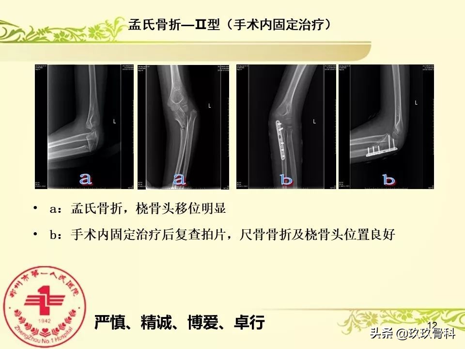 孟氏骨折功能训练多久能恢复正常,孟氏骨折中医能治吗