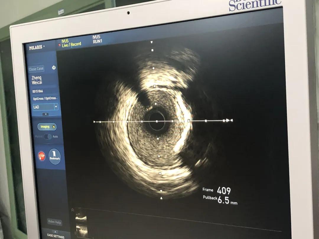 心血管新技术新项目,新技术为心血管保驾护航