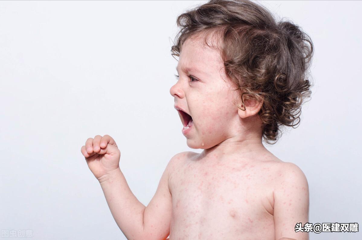 炉甘石洗剂男性慎用,炉甘石洗剂的妙用