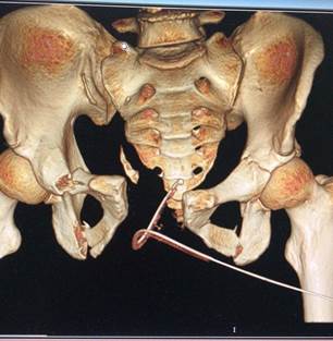 北京积水潭骨折修复,北京积水潭治疗陈旧骨盆骨折