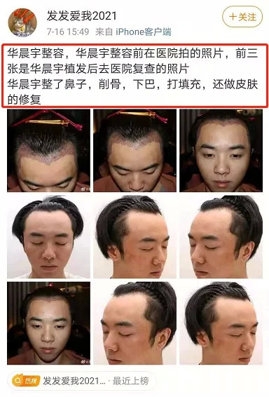 华晨宇植发整容图曝光!粉丝呼吁这是私人隐私,网友:笑到肚子疼