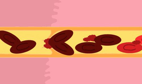 这两个动作会让血栓瞬间脱落,如何防止血栓脱落堵塞血管