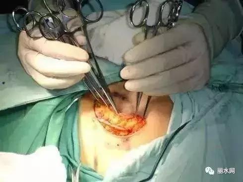 男性也会得乳腺癌?丽水男子得乳腺癌,全乳切除!有这种症状的男性朋友要重视了