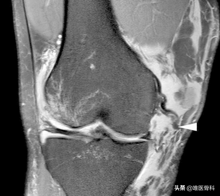 膝关节内侧副韧带损伤的诊疗进展,膝关节内侧副韧带损伤的正确叙述