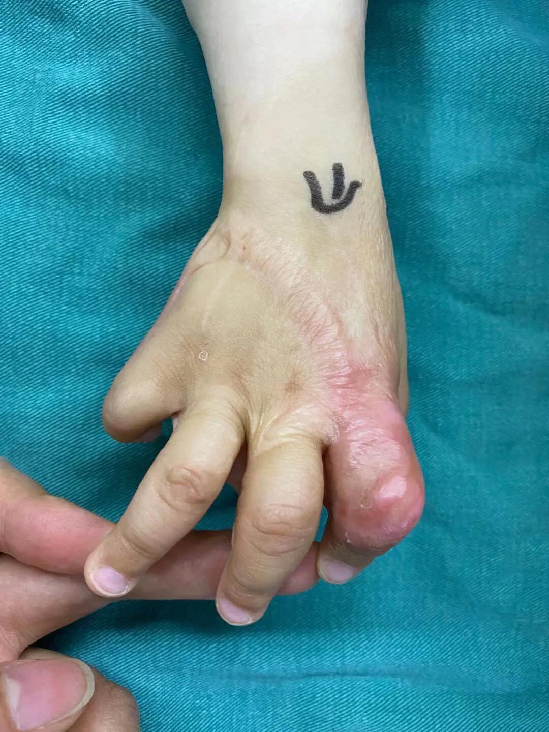 儿童烫伤的疤痕,三度烫伤疤痕为啥挛缩