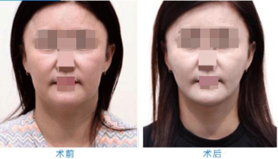 消除法令纹做什么项目,消除法令纹按什么穴