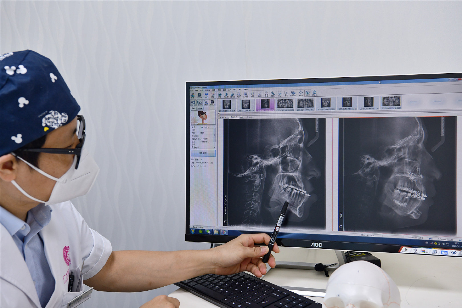 严重骨性地包天正畸效果,地包天矫正后又反颌怎么办