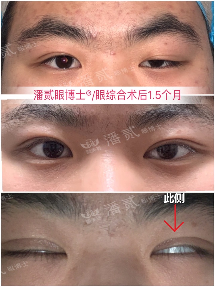 重度上睑下垂术后为什么闭不上眼睛？闭眼不全怎么护理好？