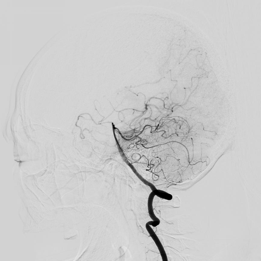 神经外科介入发展与规划,神经外科治疗脑血管病吗