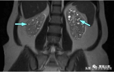 18种泌尿生殖系统常见疾病MR诊断总结