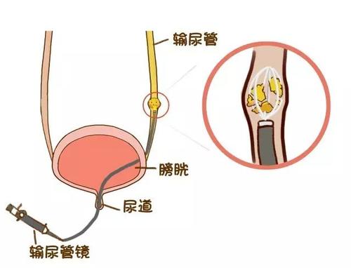 1.5厘米的肾结石没有症状要治疗吗,肾结石积水没有症状可以不治疗吗