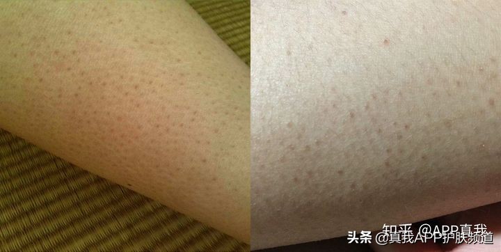 去鸡皮肤真实有效的方法,鸡皮肤如何彻底治愈