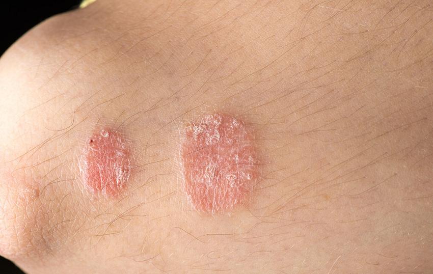 银屑病大量掉屑是脏东西吗,银屑病开始掉屑了吗