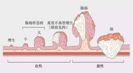 所有的息肉都会变成癌吗,所有结肠息肉都可能癌变吗
