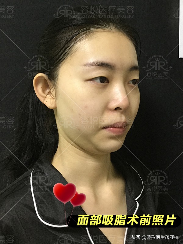 面部吸脂后如何快速消肿,面部吸脂去哪做