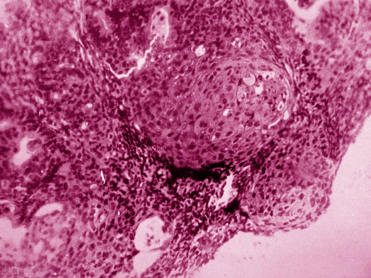 子宫内膜癌出血的颜色是什么颜色,子宫内膜癌出血多久才能判断是癌