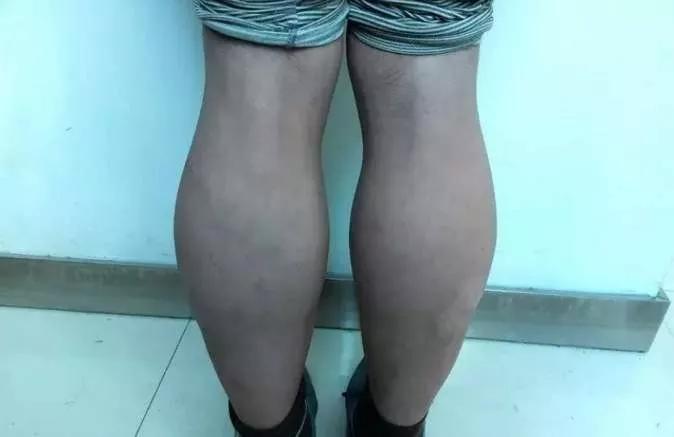 肌营养不良患者应该如何护理呢？