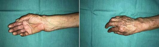 85岁老太摔倒被扶,八旬老太摔骨折