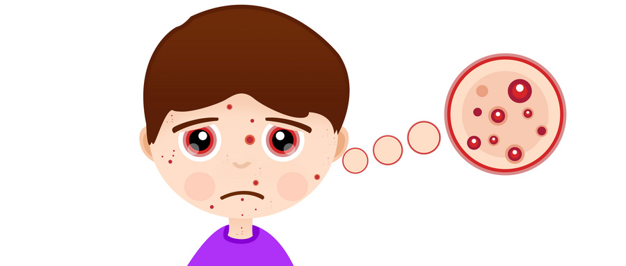 女人下巴长痘痘的原因去除小妙招,快来大姨妈下巴长痘痘是什么原因