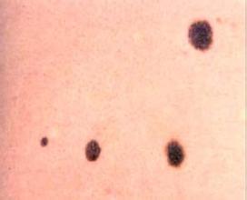 什么是色素痣如何选择治疗,色素痣怎么治疗才能除根