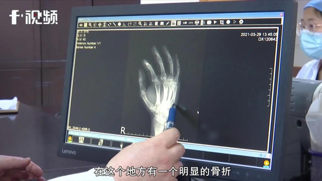 长沙一位父亲因愤怒捶桌致手掌骨折了，都是它惹的祸